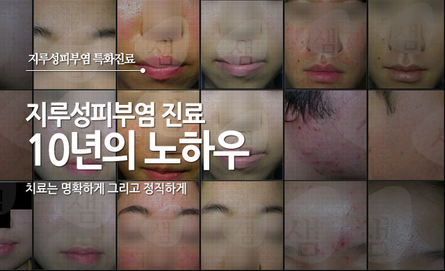 지루성피부염진료 10년의노하우