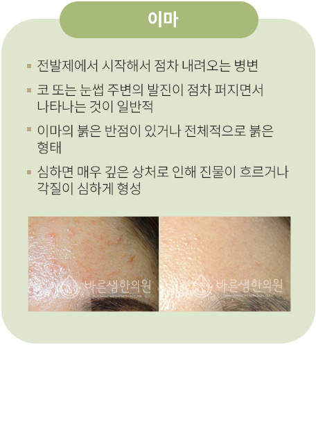 이마
