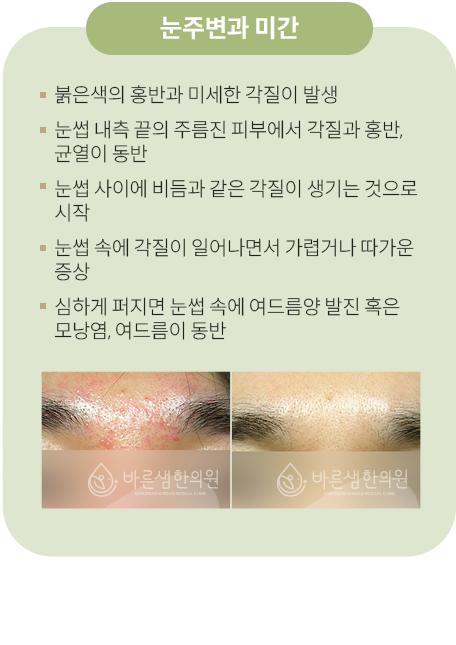 눈주변과미간