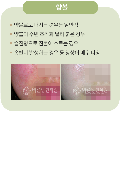 양볼