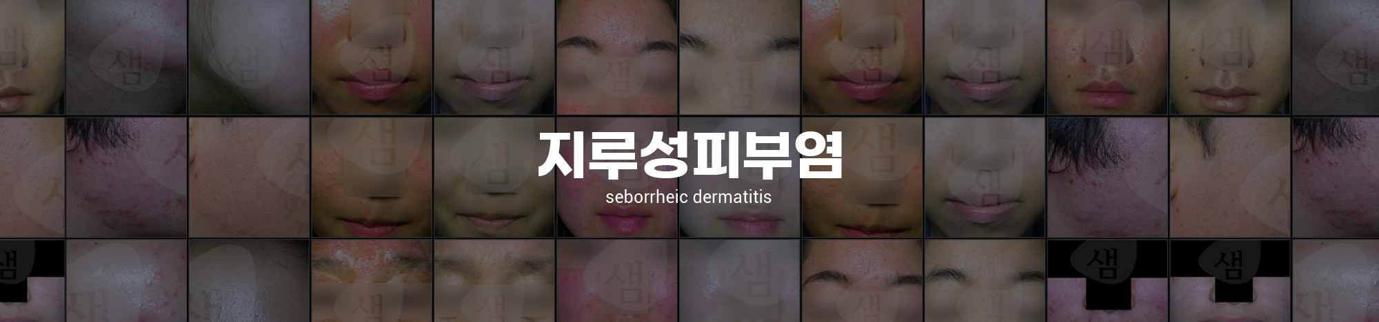 지루성피부염