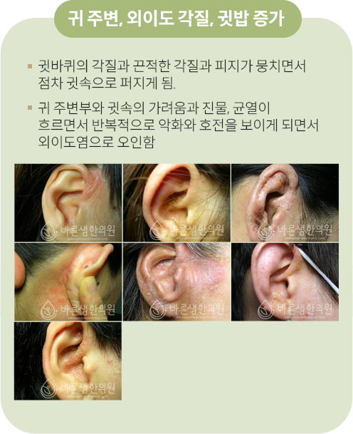눈주변과미간
