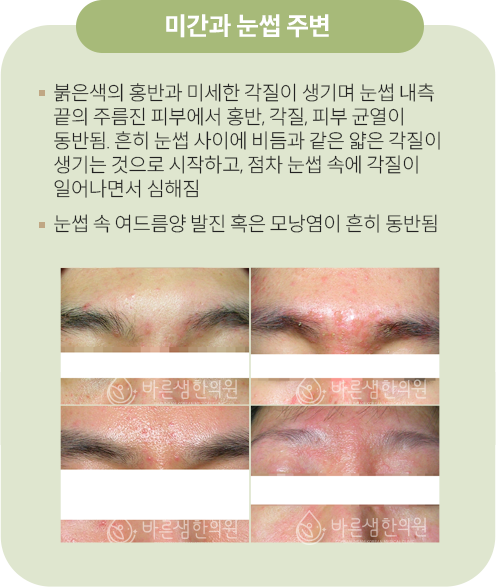 눈주변과미간